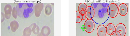 Malaria (CBC count)