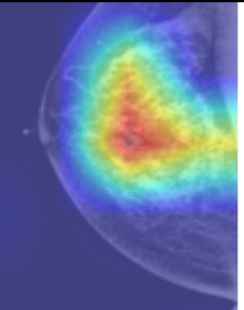 Mammogram